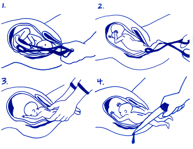 Реферат: Partial Birth Abortion Mercy Or Infanticide Essay